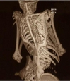 Scanner d'un enfant atteint de FOP